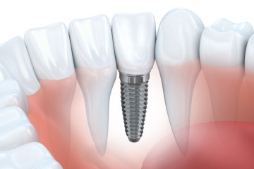Oral Implants